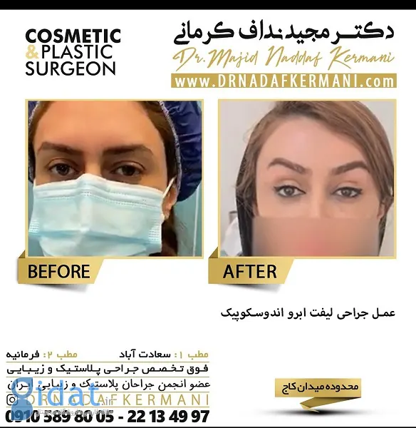 لیفت ﺍبرو چیست و با چه روش هایی انجام می‌شود؟